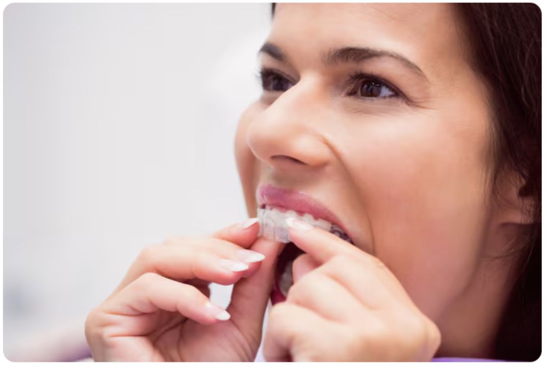 affordable invisible braces pricing in india 